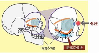 眼窩骨折.jpg